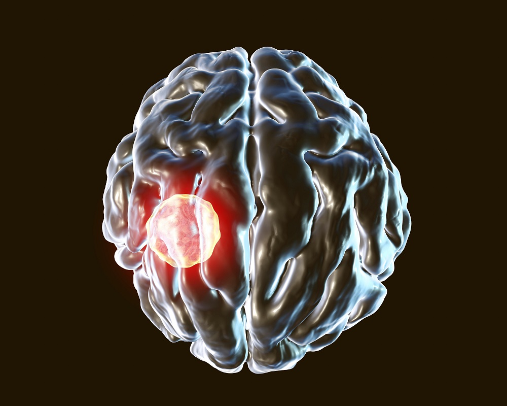 The Dentist - Oral bacteria and brain abscesses linked The Dentist - Oral bacteria and brain abscesses linked