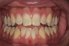 Fig 1: The patient was not happy with the appearance of his upper four front teeth and, more specifically, his crooked and crowded lower anterior teeth.